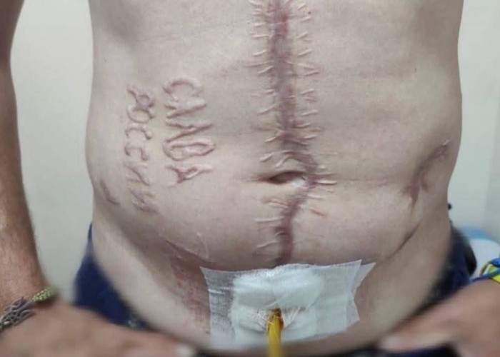 Calvarul unui prizonier ucrainean care a fost torturat de militarii ruși, grav rănit și căruia i-a fost arsă pe abdomen inscripția "Glorie, Rusiei!"