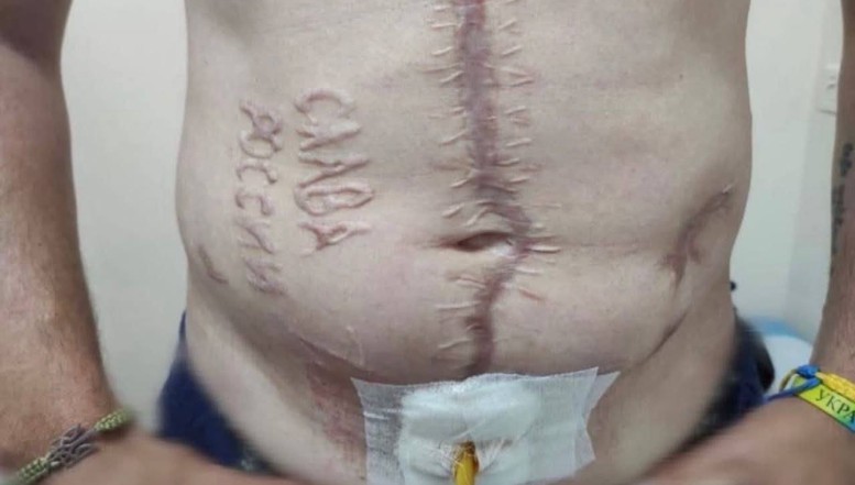 Calvarul unui prizonier ucrainean care a fost torturat de militarii ruși, grav rănit și căruia i-a fost arsă pe abdomen inscripția "Glorie, Rusiei!"
